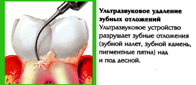 Профессиональная гигиена полости рта